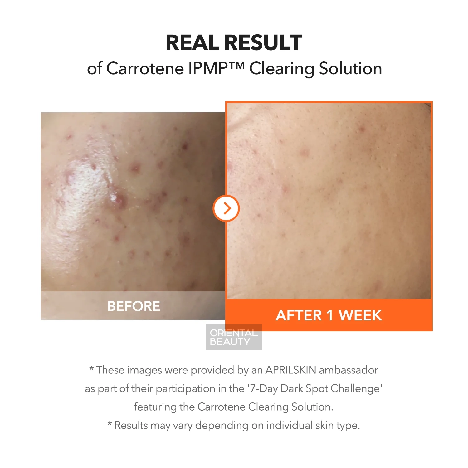 Aprilskin Carrotene IPMP Clearing Solution 20ml